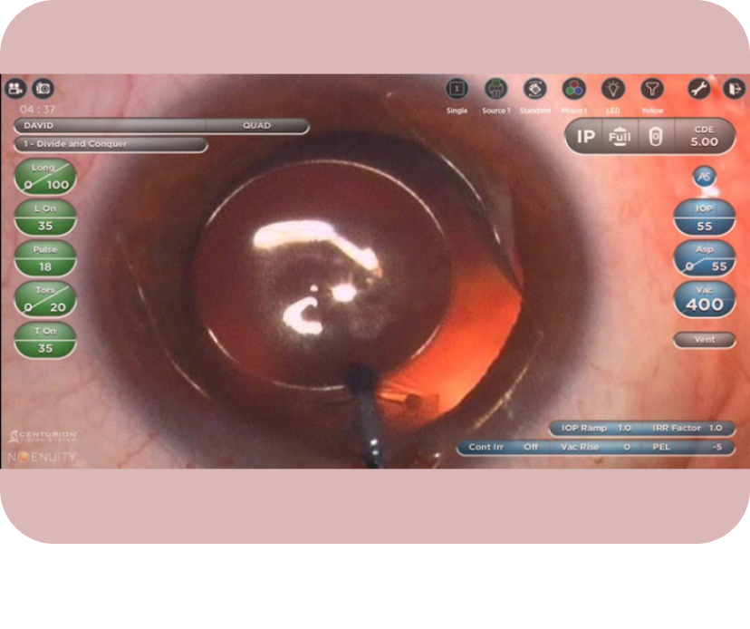 眼球クローズアップ画像に、NGENUITY®のデジタルオーバーレイで患者情報や手術データを表示したもの。