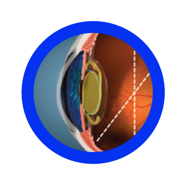 Less variability of anterior chamber depth with more stable post-op refraction7