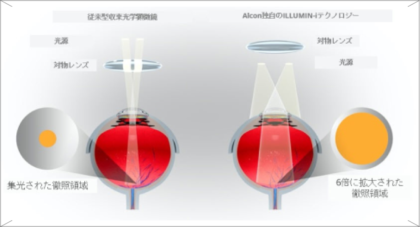 RevaliaのIllumin-Iテクノロジーは、最新の軸上照明と比較して6倍の赤色反射帯を作り出すことを示す画像。再生ボタンが動画であることを示している。